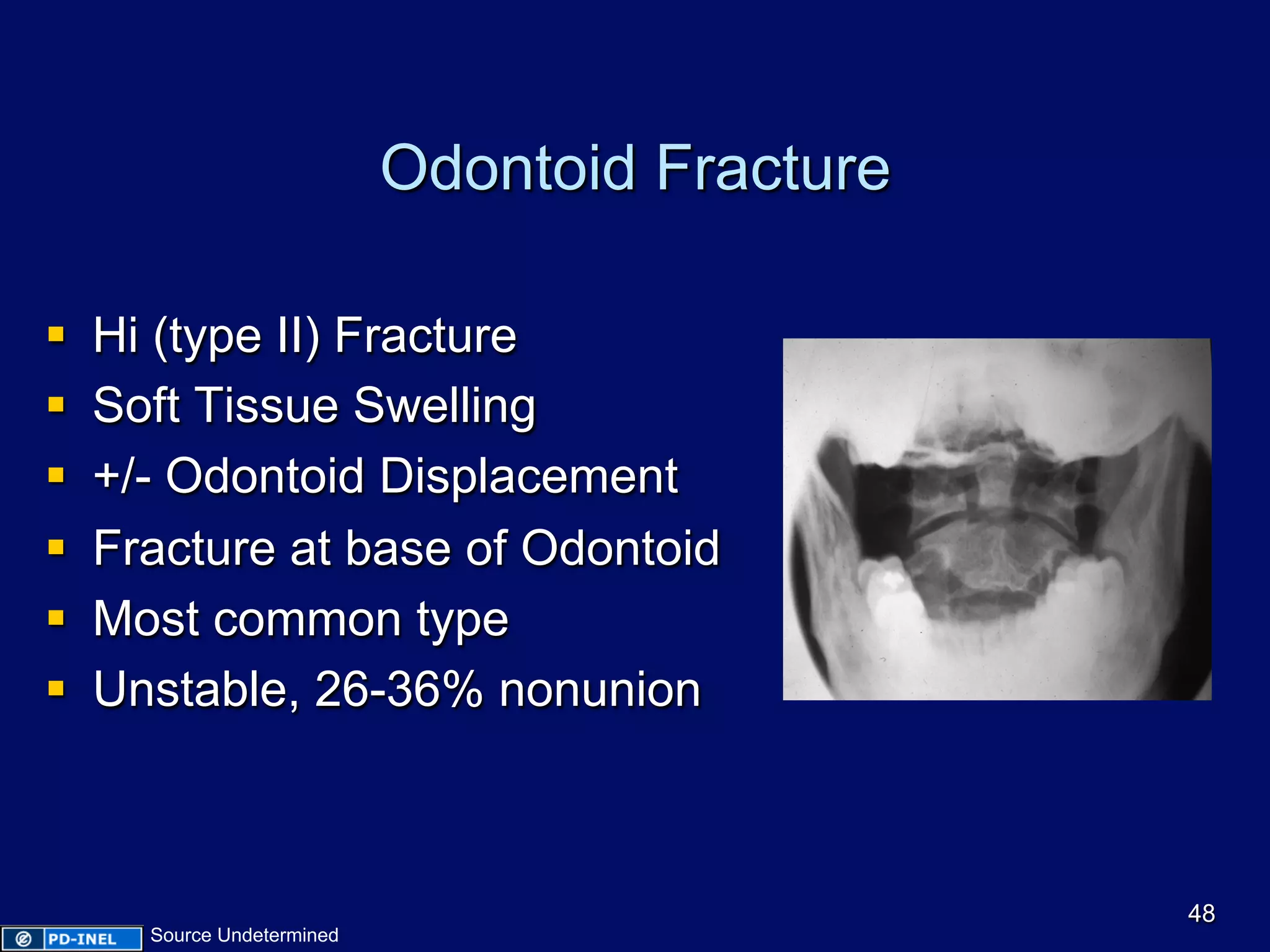 Odontoid Fracture
§  Hi (type II) Fracture
§  Soft Tissue Swelling
§  +/- Odontoid Displacement
§  Fracture at base of Odontoid
§  Most common type
§  Unstable, 26-36% nonunion
48
Source Undetermined
 