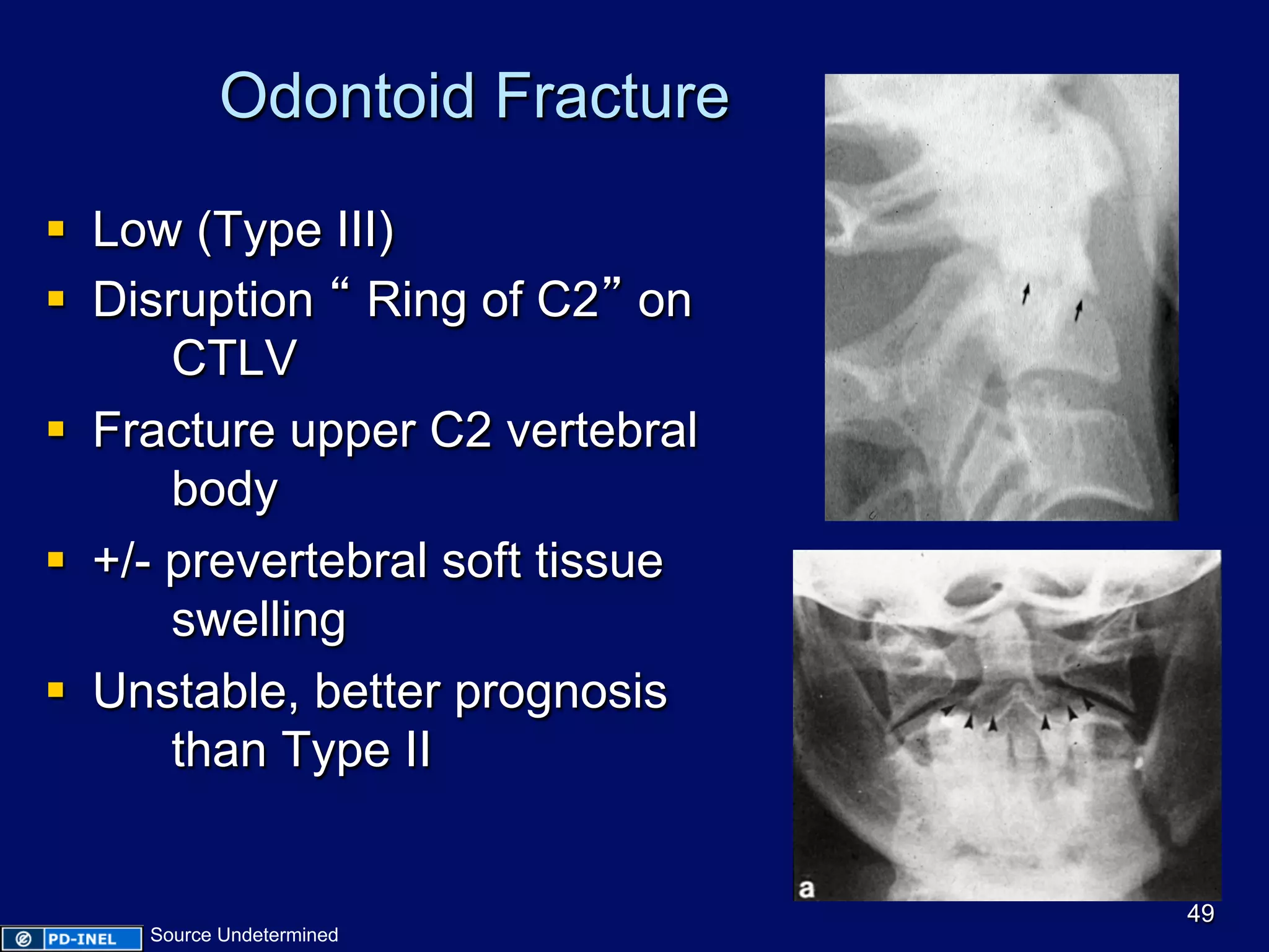 Odontoid Fracture
§  Low (Type III)
§  Disruption “ Ring of C2” on
CTLV
§  Fracture upper C2 vertebral
body
§  +/- prevertebral soft tissue
swelling
§  Unstable, better prognosis
than Type II
49
Source Undetermined
 