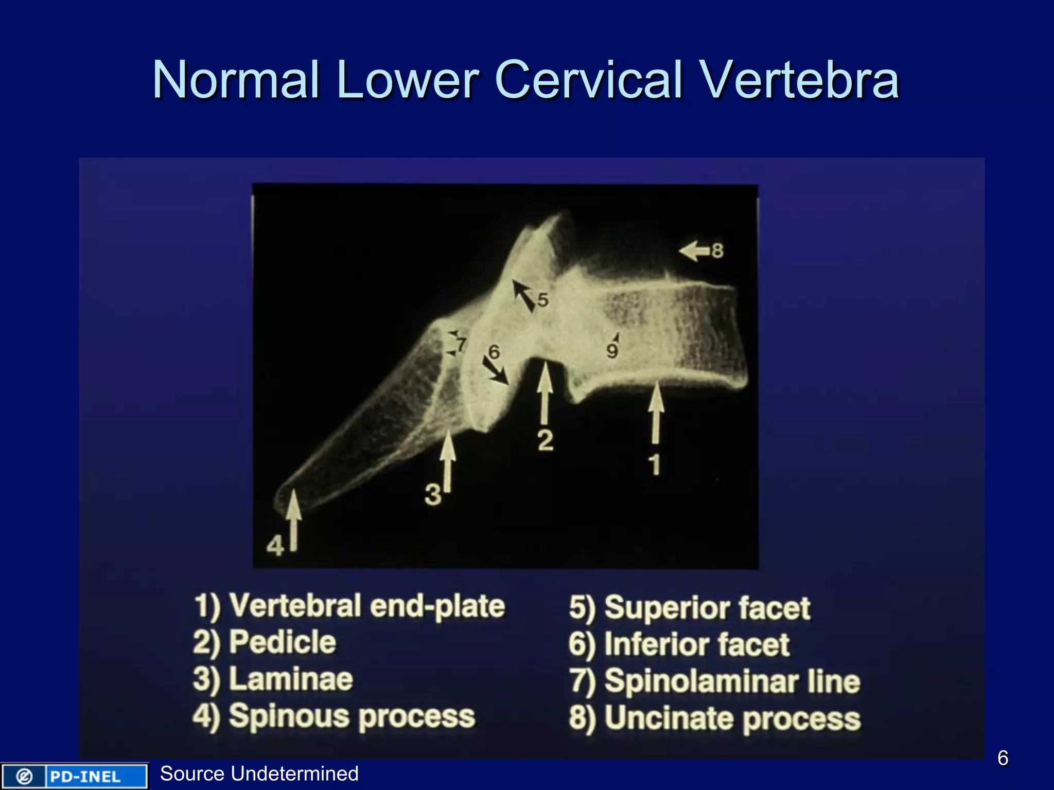 Normal Lower Cervical Vertebra
6
Source Undetermined
 
