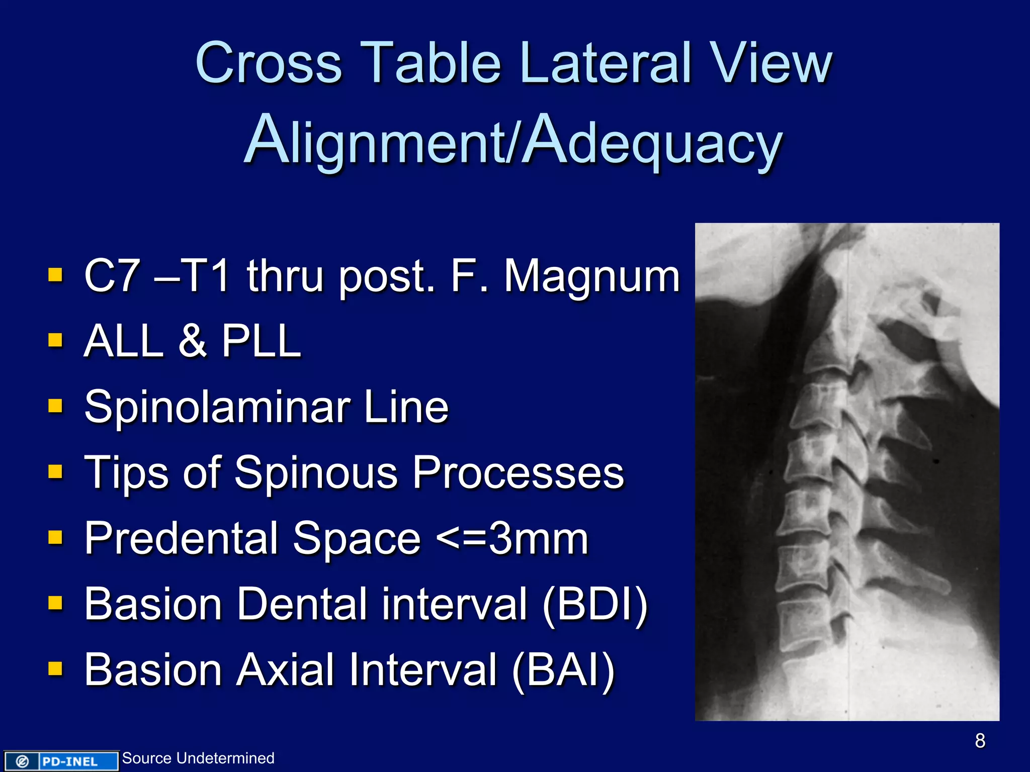 Cross Table Lateral View
Alignment/Adequacy
§  C7 –T1 thru post. F. Magnum
§  ALL & PLL
§  Spinolaminar Line
§  Tips of Spinous Processes
§  Predental Space <=3mm
§  Basion Dental interval (BDI)
§  Basion Axial Interval (BAI)
8
Source Undetermined
 