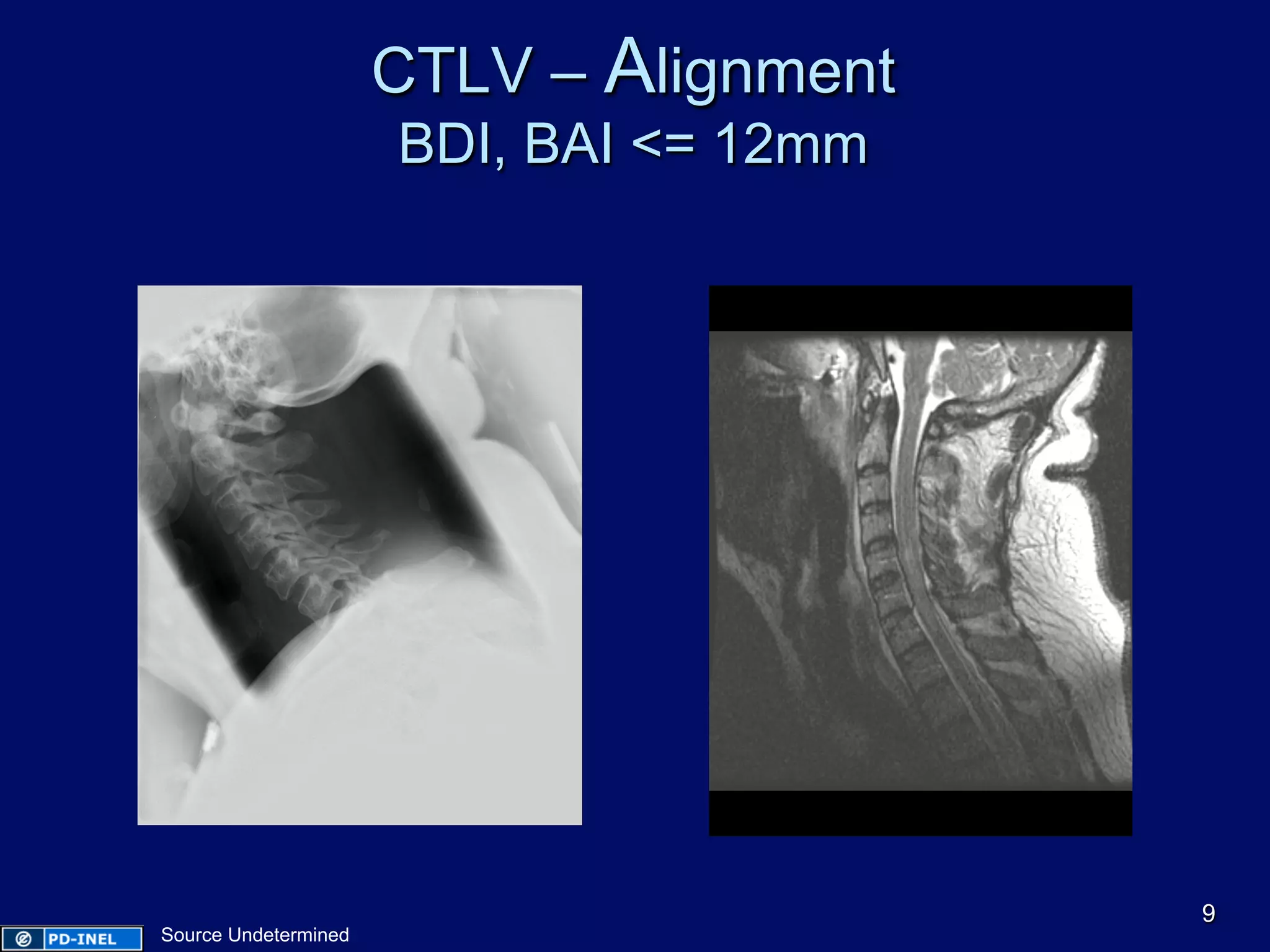 CTLV – Alignment
BDI, BAI <= 12mm
9
Source Undetermined
 