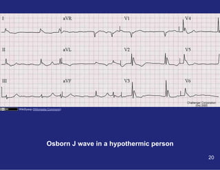 WikiSysop (Wikimedia Commons)

Osborn J wave in a hypothermic person
20

 