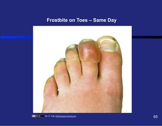 Frostbite on Toes – Same Day

Dr. S. Falz (Wikimedia Commons)

65

 