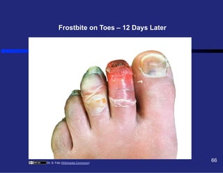 Frostbite on Toes – 12 Days Later

Dr. S. Falz (Wikimedia Commons)

66

 