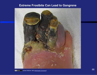 Extreme Frostbite Can Lead to Gangrene

James Heilman, MD (Wikimedia Commons)

68

 