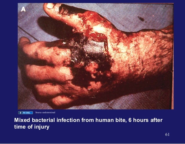 Cefazolin Dog Bite Cefazolin Dog Bite