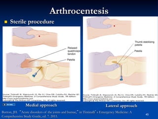 Arthrocentesis
 

Sterile procedure

Medial approach

Lateral approach

Burton, JH. “Acute disorders of the joints and bursae,” in Tintinalli’s Emergency Medicine: A
Comprehensive Study Guide, ed. 7. 2011.

45

 