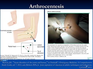 Arthrocentesis

Burton, JH. “Acute disorders of the joints and bursae,” in Tintinalli’s Emergency Medicine: A Comprehensive
Study Guide, ed. 7. 2011; and, Roberts WN, Jr. Joint aspiration of injection in adults: techniques and indications.
46
UpToDate, 2012.

 