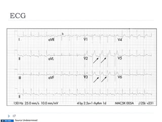 ECG
Source Undetermined
17
 