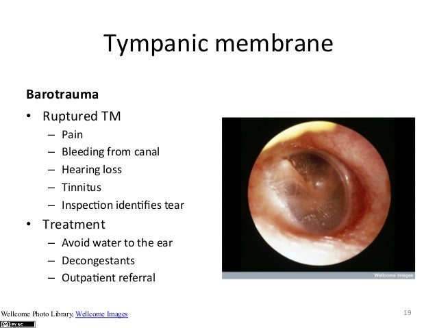 sinus barotrauma