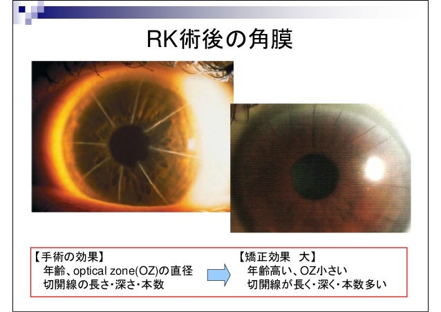 レーザー屈折矯正手術に関するご質問にお答えします