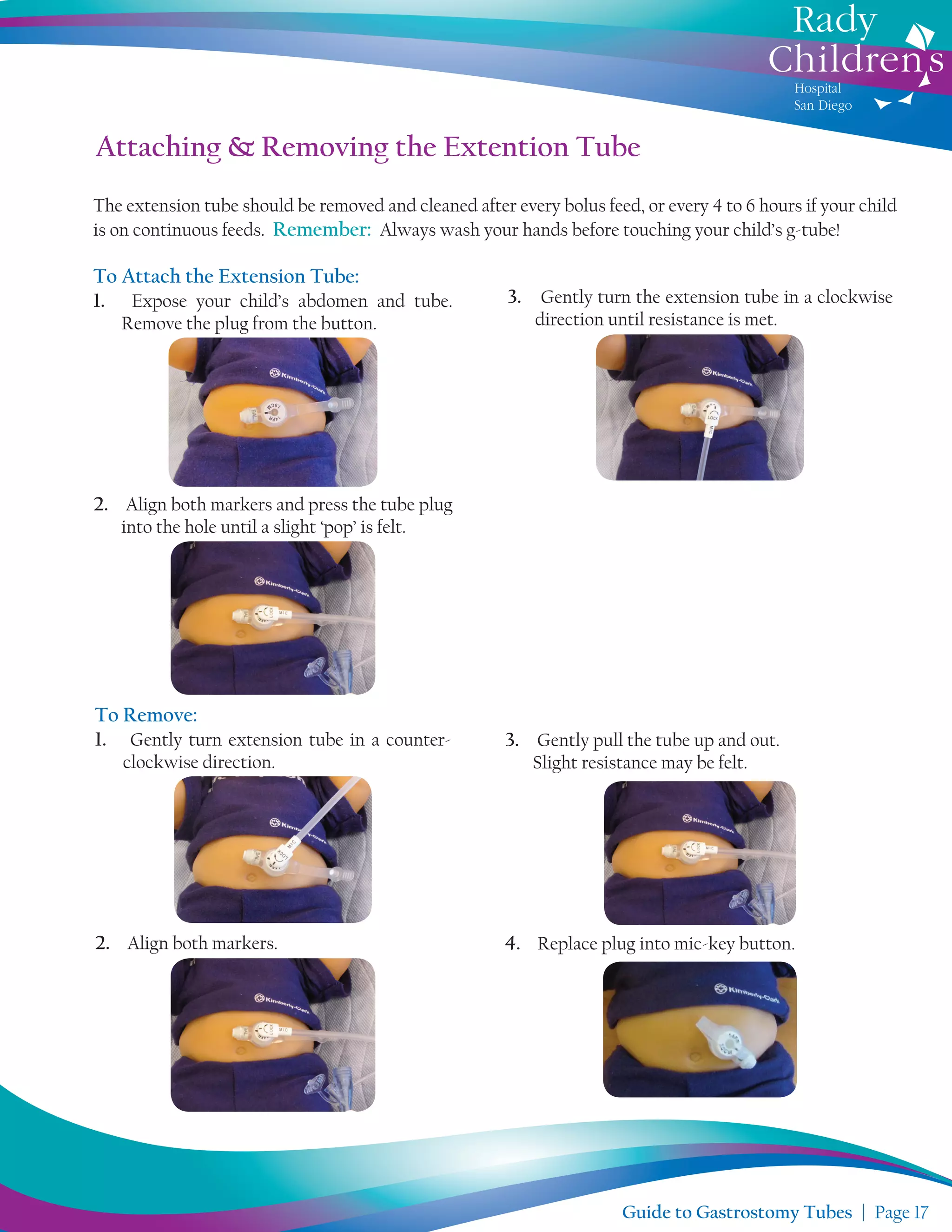Tube. Remove Guide to Gastrostomy Tubes | PDF