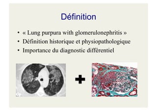 Définition
• « Lung purpura with glomerulonephritis »
• Définition historique et physiopathologique
• Importance du diagnostic différentiel
 