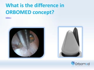 What is the difference in
ORBOMED concept?
VIDEO>>
 