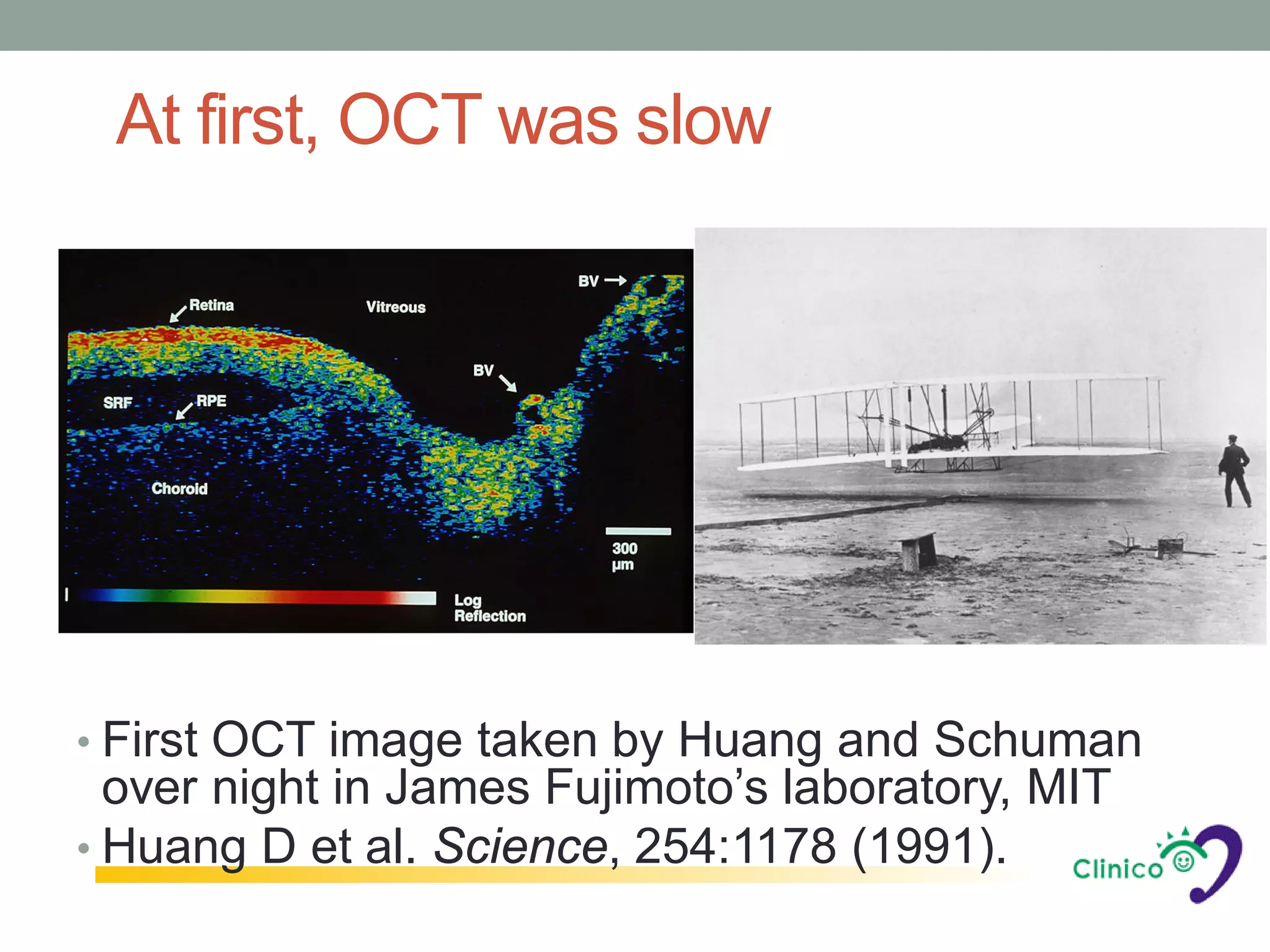 At first, OCT was slow




• First OCT image taken by Huang and Schuman
  over night in James Fujimoto’s laboratory, MIT
• Huang D et al. Science, 254:1178 (1991).
 