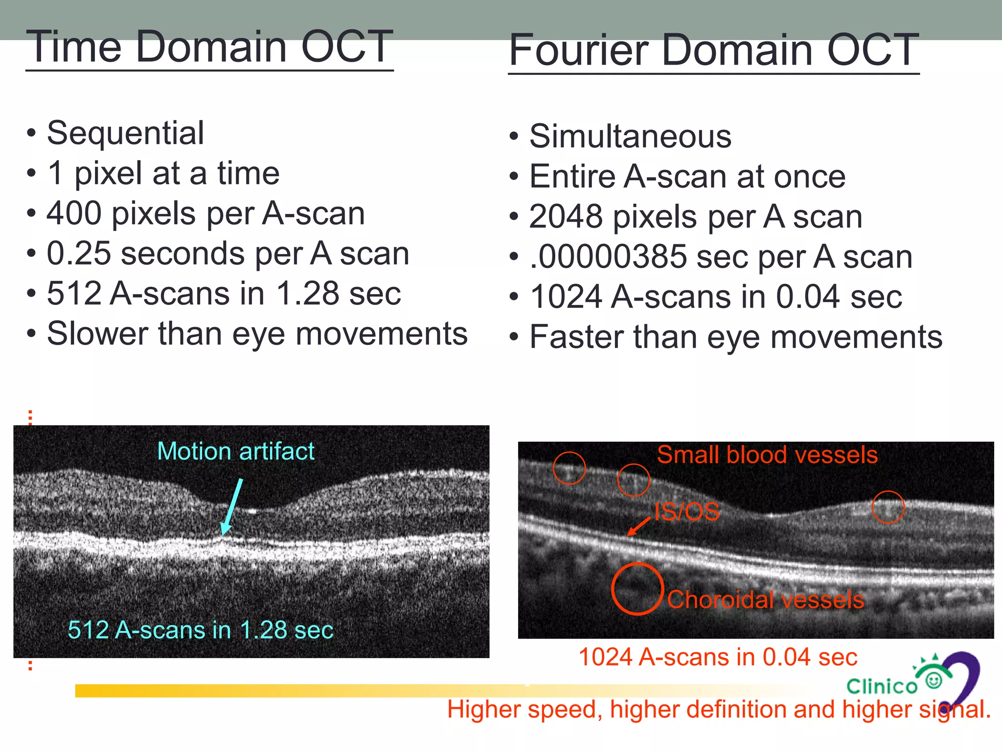 Time Domain OCT                  Fourier Domain OCT
• Sequential                     • Simultaneous
• 1 pixel at a time              • Entire A-scan at once
• 400 pixels per A-scan          • 2048 pixels per A scan
• 0.25 seconds per A scan        • .00000385 sec per A scan
• 512 A-scans in 1.28 sec        • 1024 A-scans in 0.04 sec
• Slower than eye movements      • Faster than eye movements


         Motion artifact                       Small blood vessels

                                              IS/OS


                                                Choroidal vessels
  512 A-scans in 1.28 sec
                                       1024 A-scans in 0.04 sec

                            Higher speed, higher definition and higher signal.
 