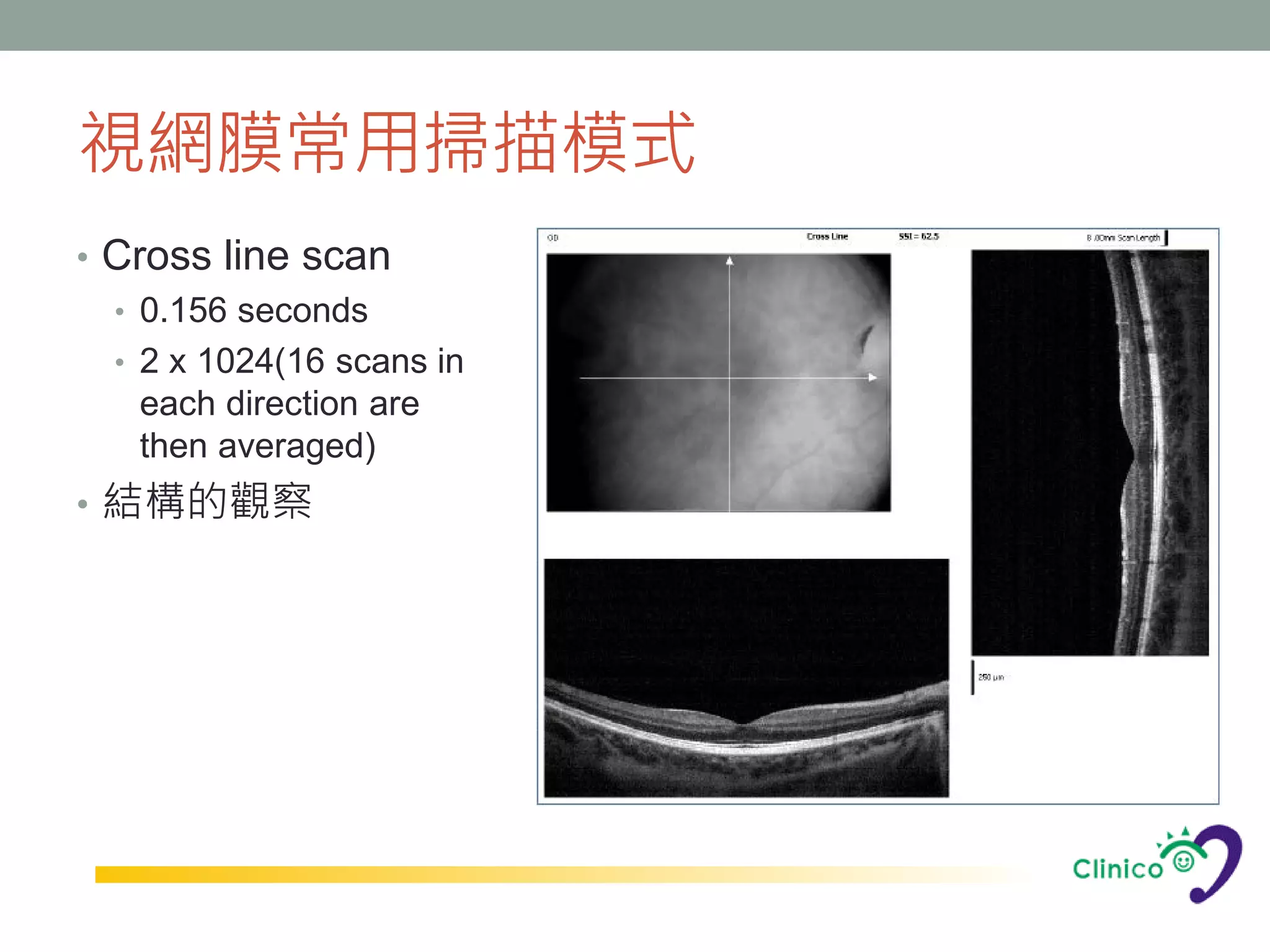 視網膜常用掃描模式
• Cross line scan
  • 0.156 seconds
  • 2 x 1024(16 scans in
    each direction are
    then averaged)
• 結構的觀察
 