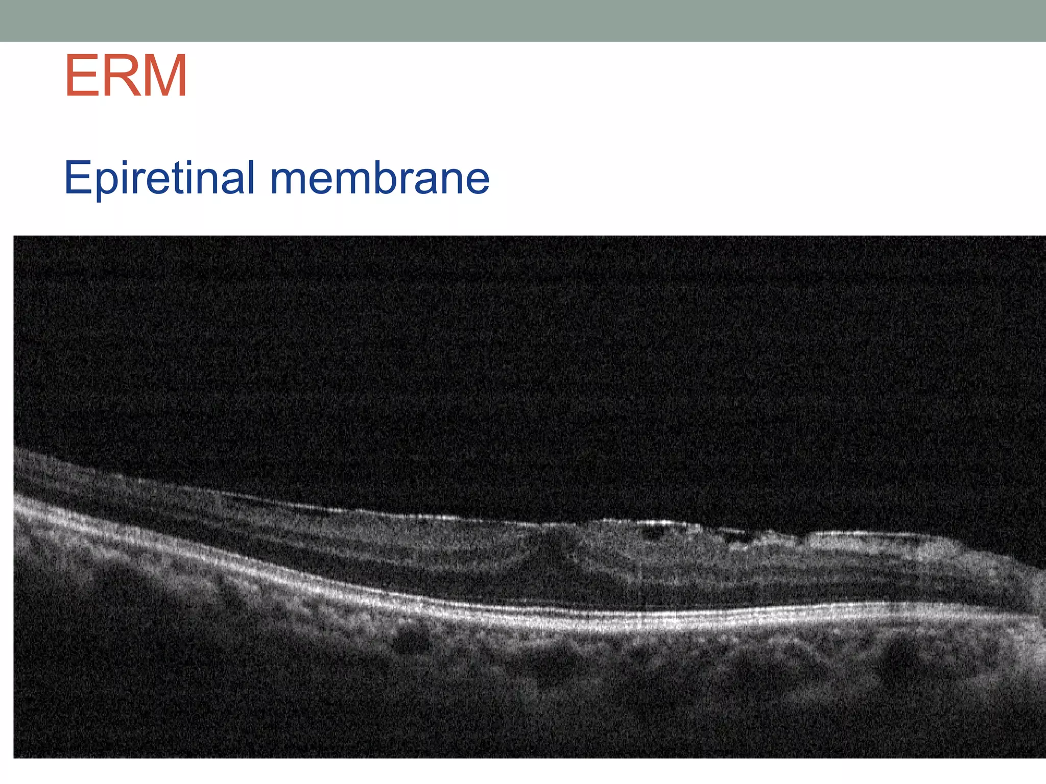 ERM
Epiretinal membrane
 