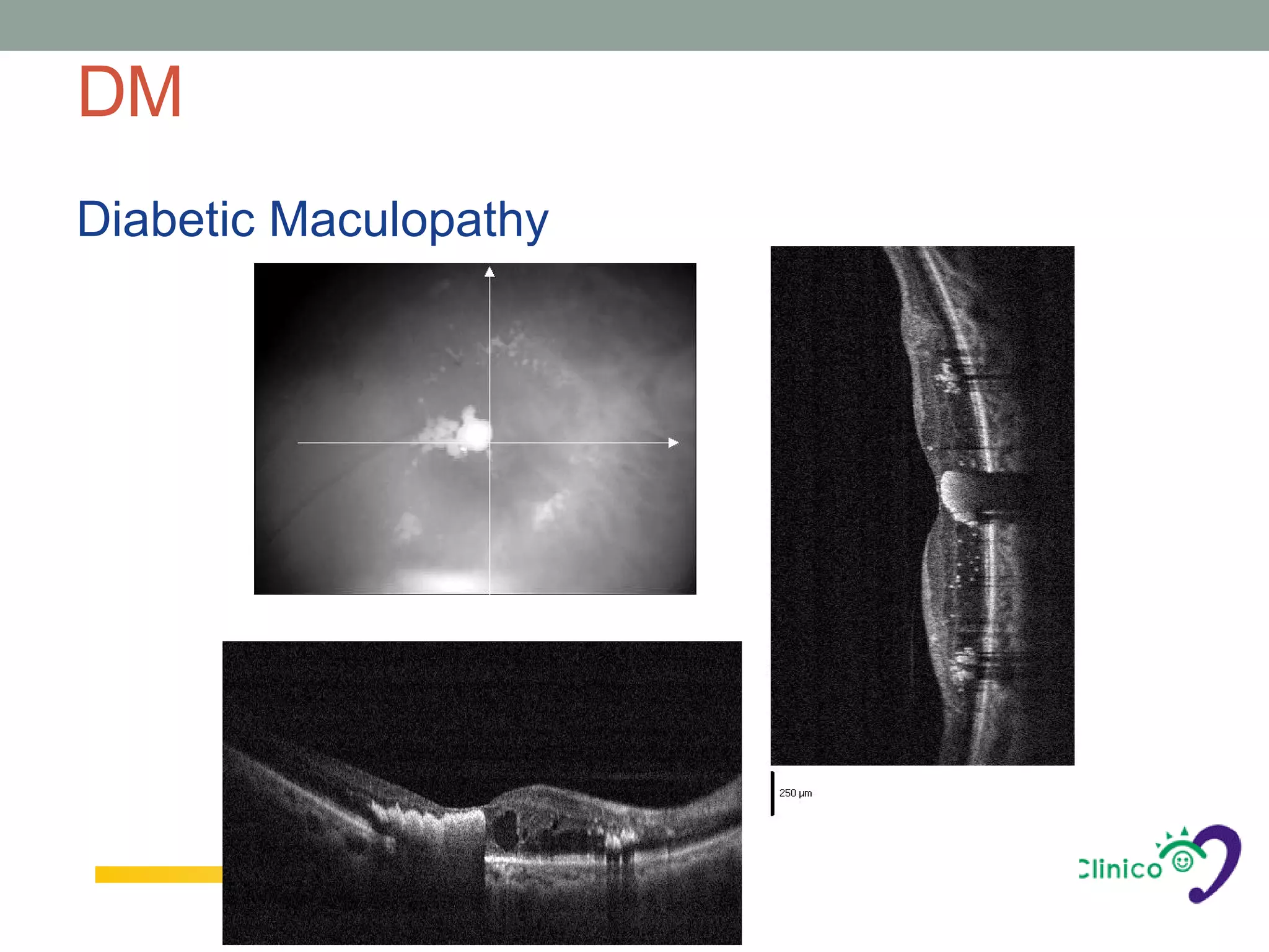 DM
Diabetic Maculopathy
 