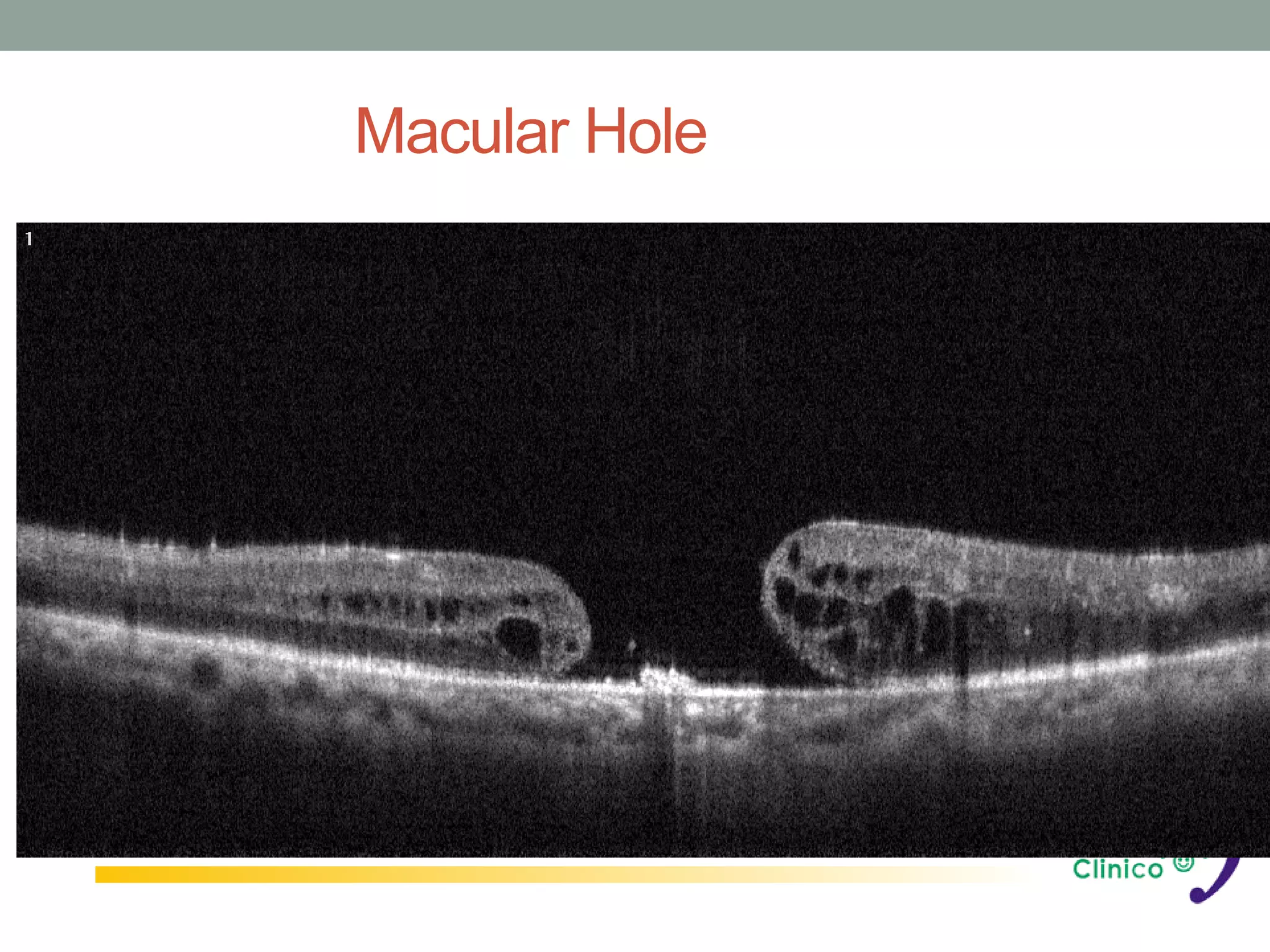 Macular Hole
 