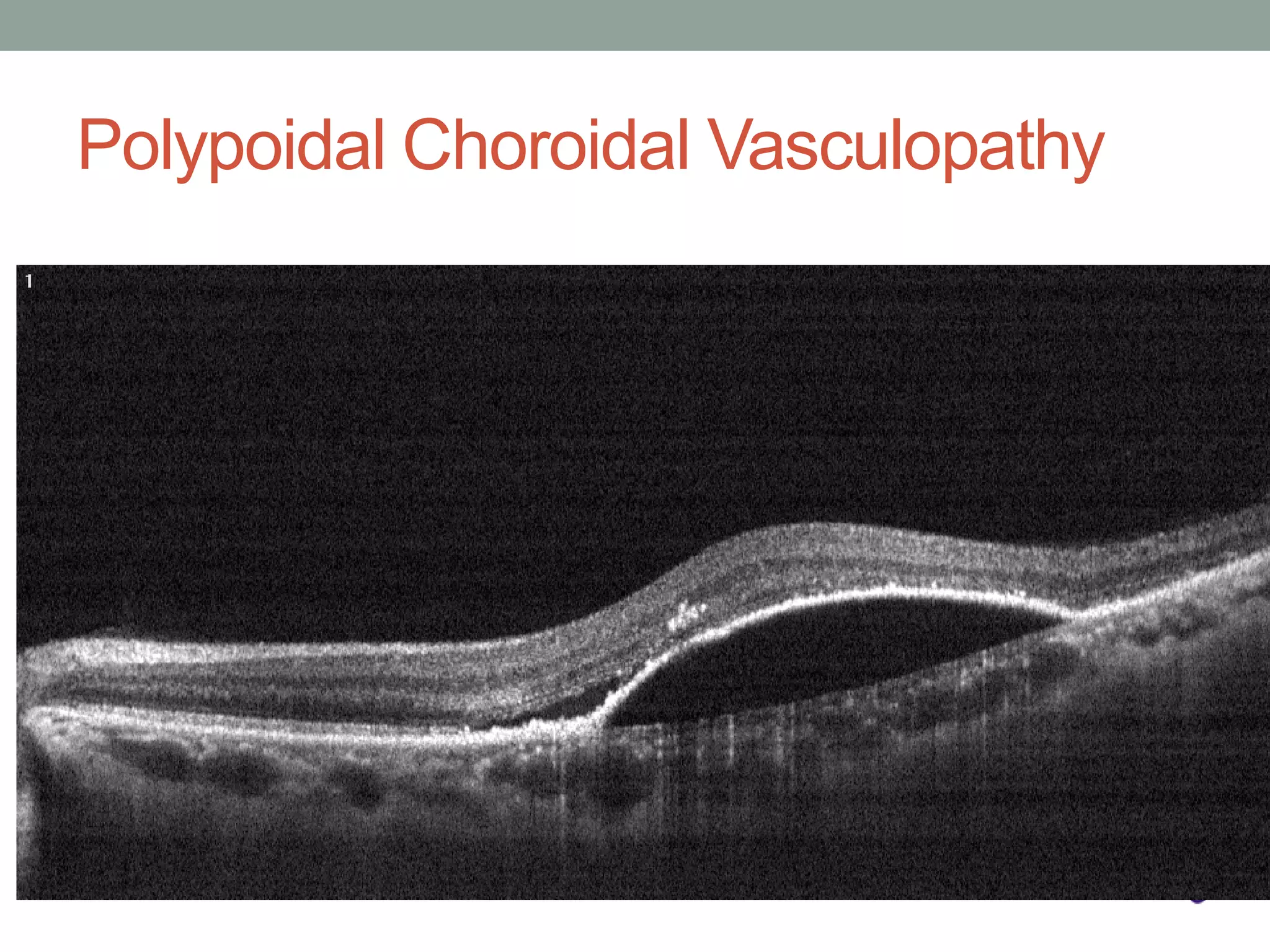Polypoidal Choroidal Vasculopathy
 