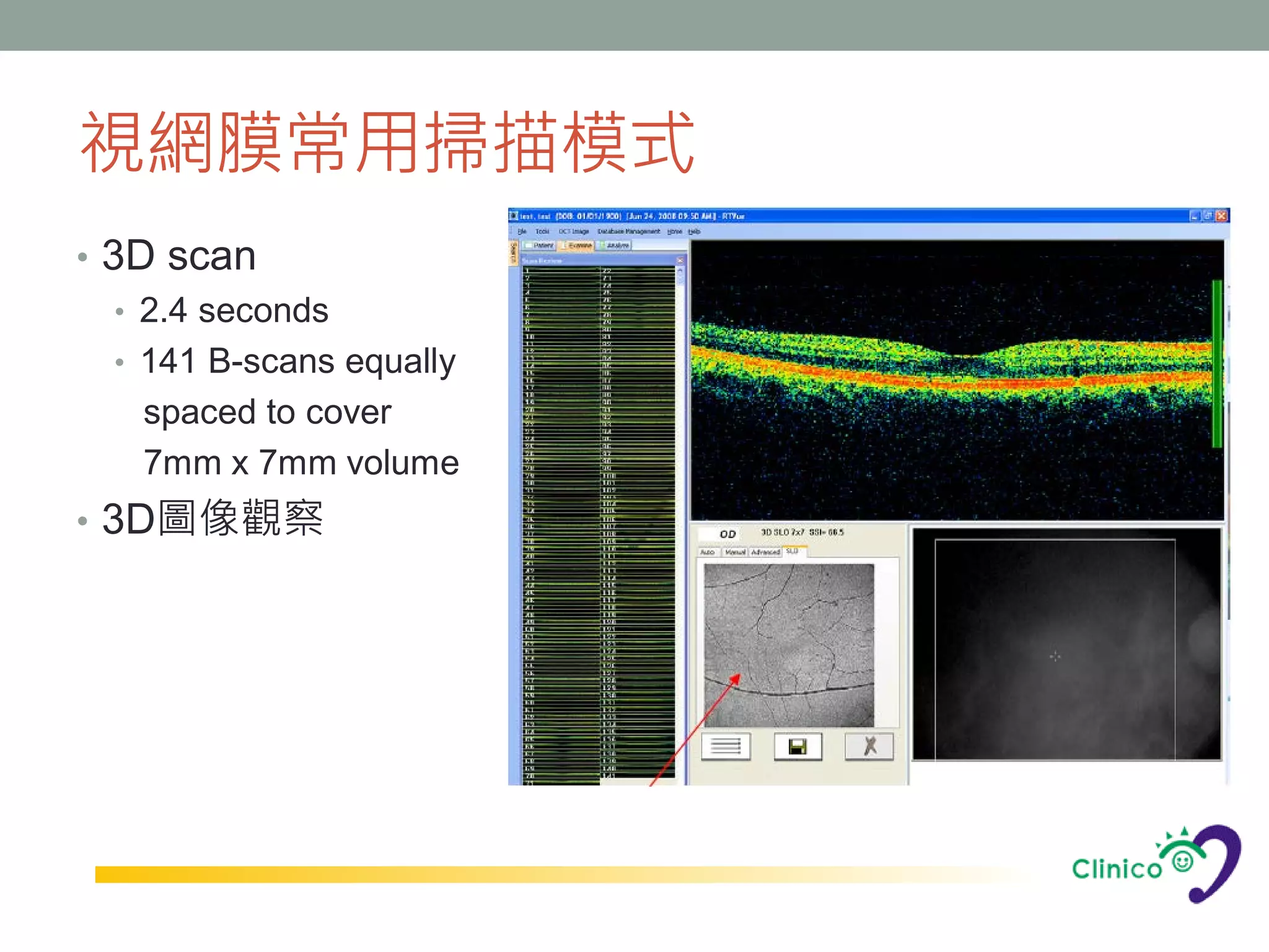 視網膜常用掃描模式
• 3D scan
   • 2.4 seconds
   • 141 B-scans equally
     spaced to cover
     7mm x 7mm volume
• 3D圖像觀察
 