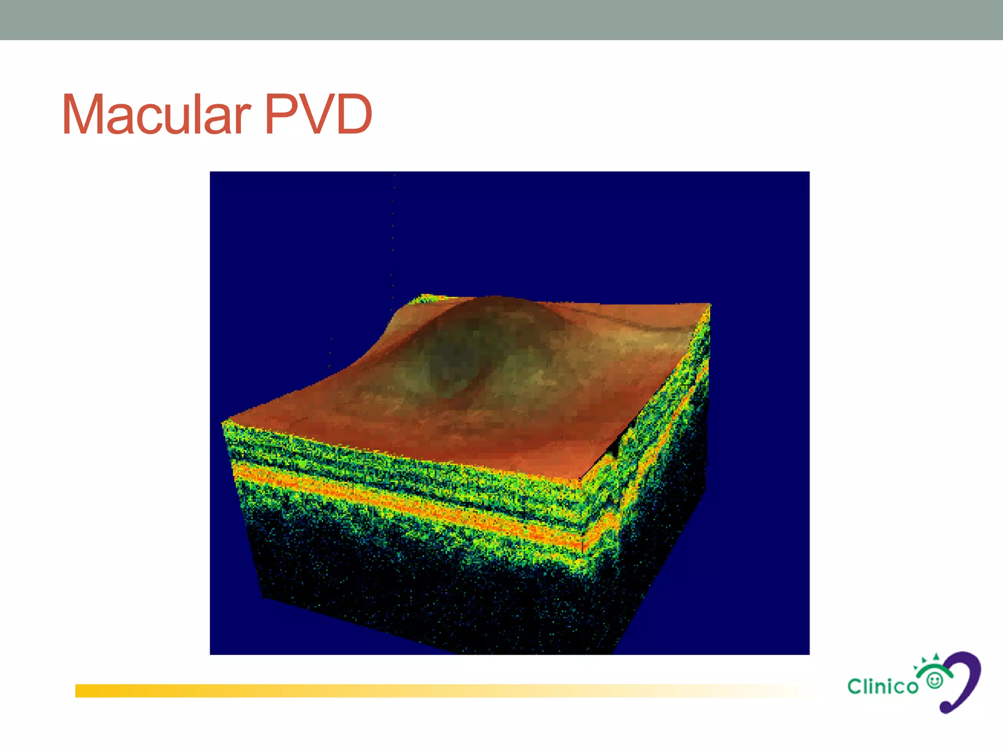 Macular PVD
 