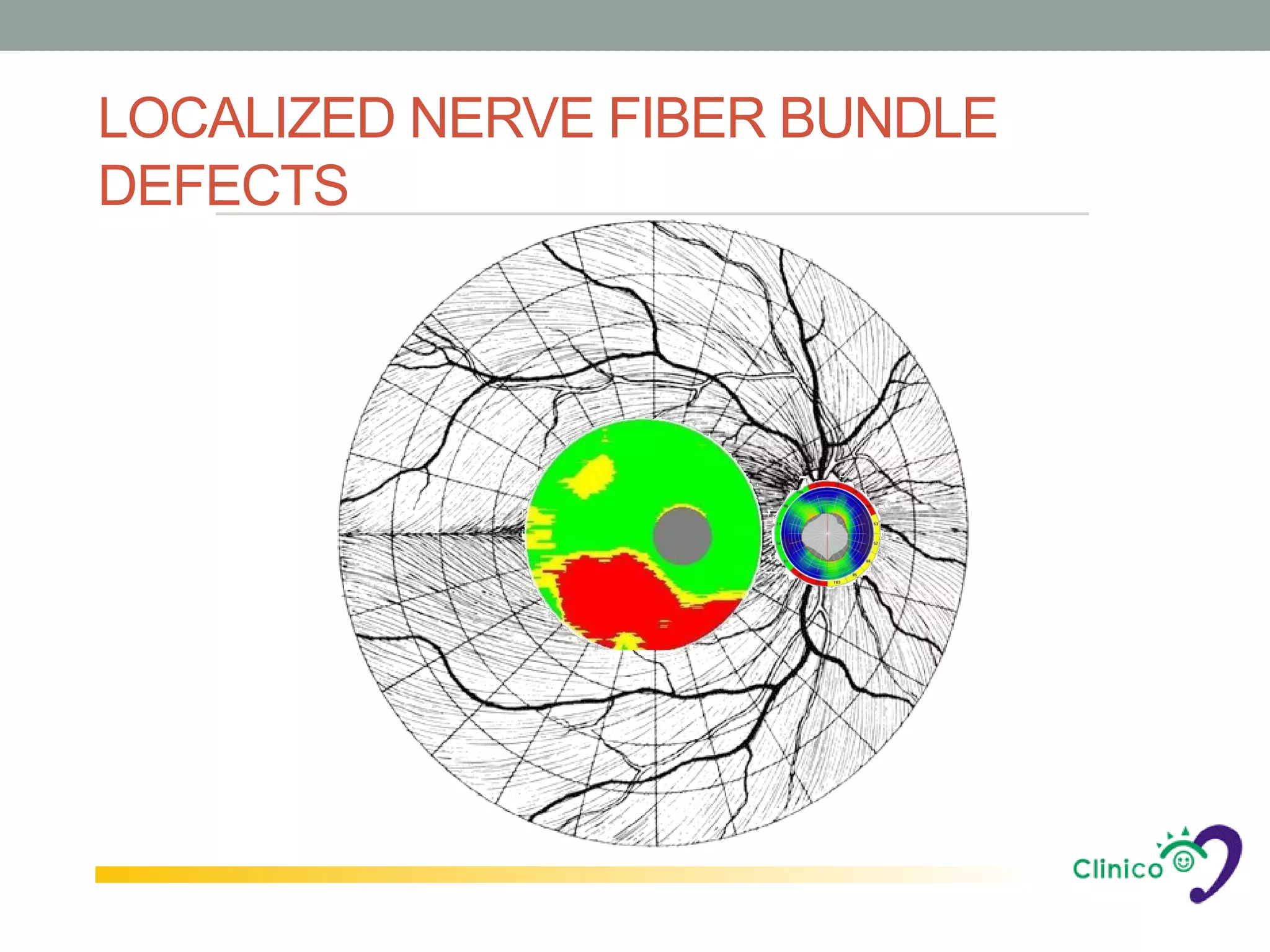 LOCALIZED NERVE FIBER BUNDLE
DEFECTS
 
