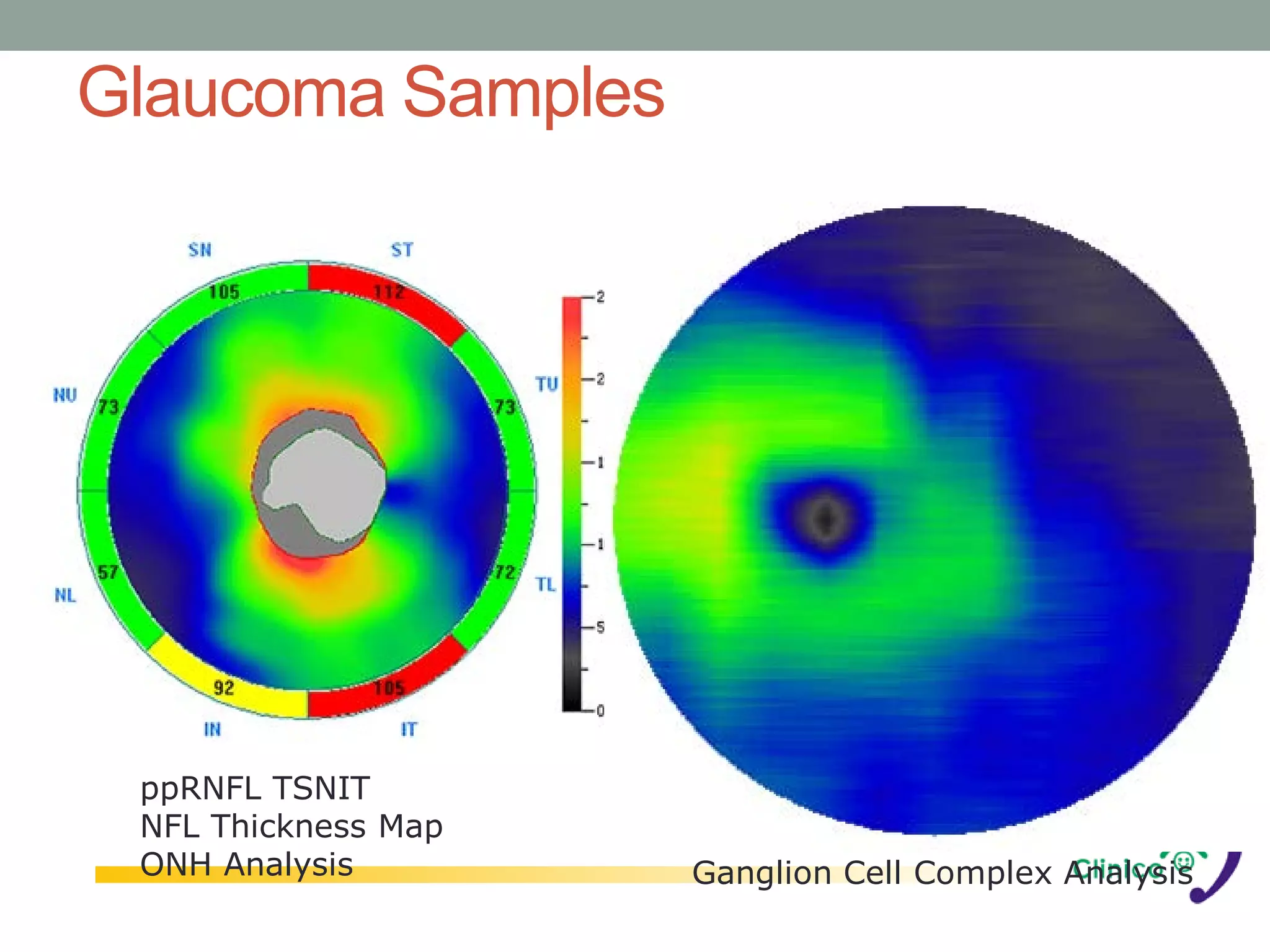 Glaucoma Samples




 ppRNFL TSNIT
 NFL Thickness Map
 ONH Analysis        Ganglion Cell Complex Analysis
 