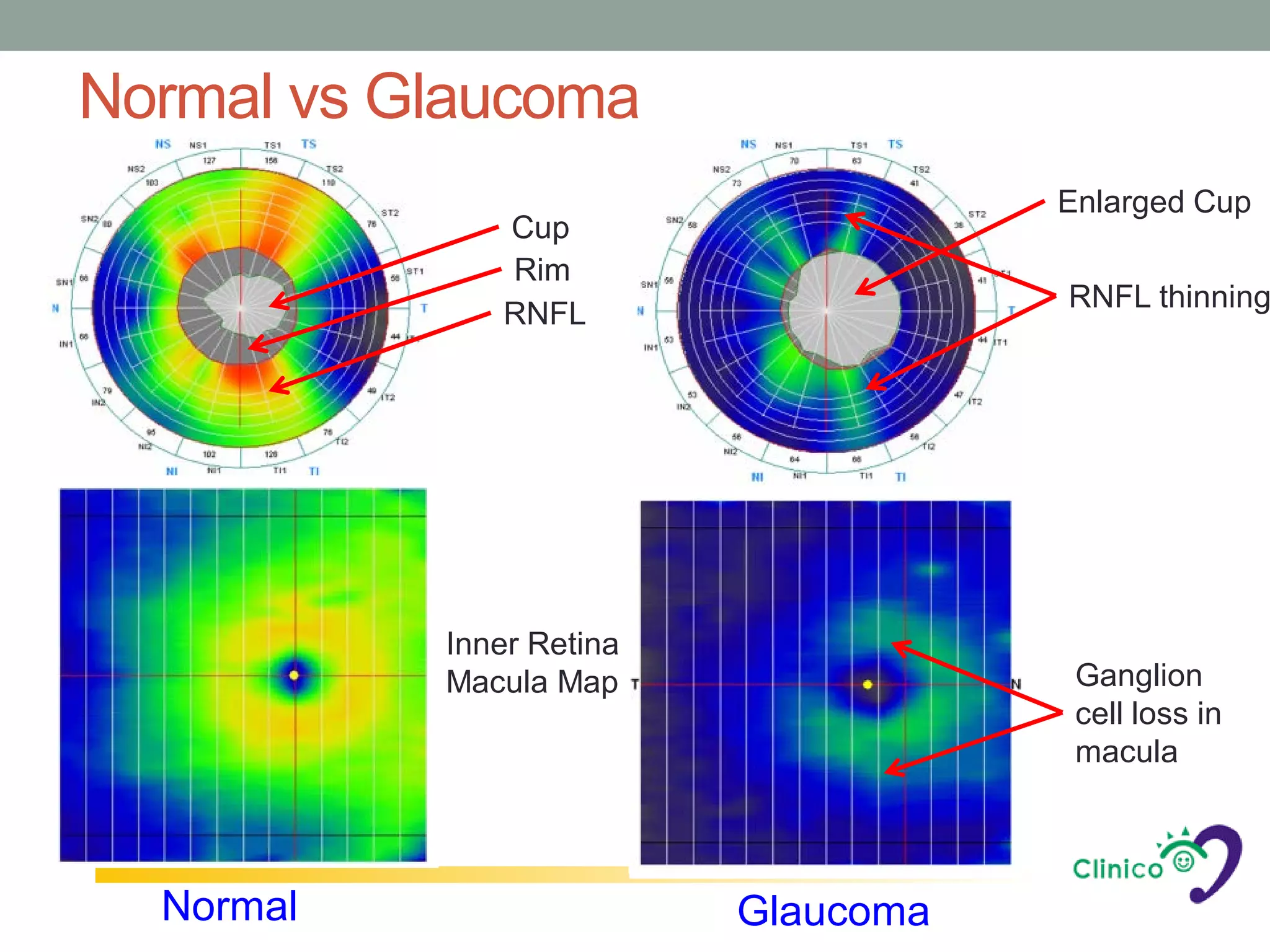 Normal vs Glaucoma
                                     Enlarged Cup
              Cup
              Rim
                                     RNFL thinning
              RNFL




           Inner Retina
           Macula Map                 Ganglion
                                      cell loss in
                                      macula



  Normal                  Glaucoma
 