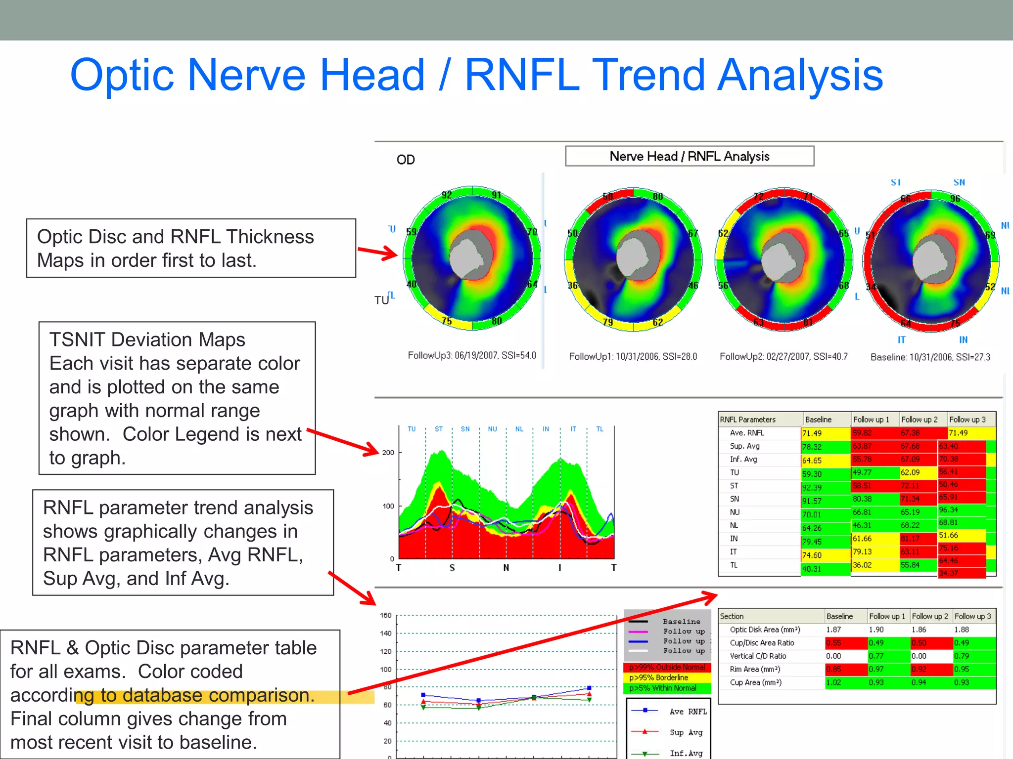 Optic Nerve Head / RNFL Trend Analysis


  Optic Disc and RNFL Thickness
  Maps in order first to last.
                                    TU


    TSNIT Deviation Maps
    Each visit has separate color
    and is plotted on the same
    graph with normal range
    shown. Color Legend is next
    to graph.

   RNFL parameter trend analysis
   shows graphically changes in
   RNFL parameters, Avg RNFL,
   Sup Avg, and Inf Avg.


RNFL & Optic Disc parameter table
for all exams. Color coded
according to database comparison.
Final column gives change from                 58
most recent visit to baseline.
 