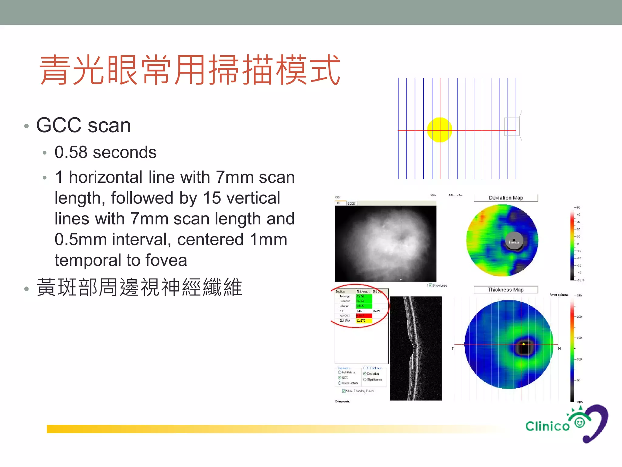 青光眼常用掃描模式
• GCC scan
  • 0.58 seconds
  • 1 horizontal line with 7mm scan
    length, followed by 15 vertical
    lines with 7mm scan length and
    0.5mm interval, centered 1mm
    temporal to fovea
• 黃斑部周邊視神經纖維
 