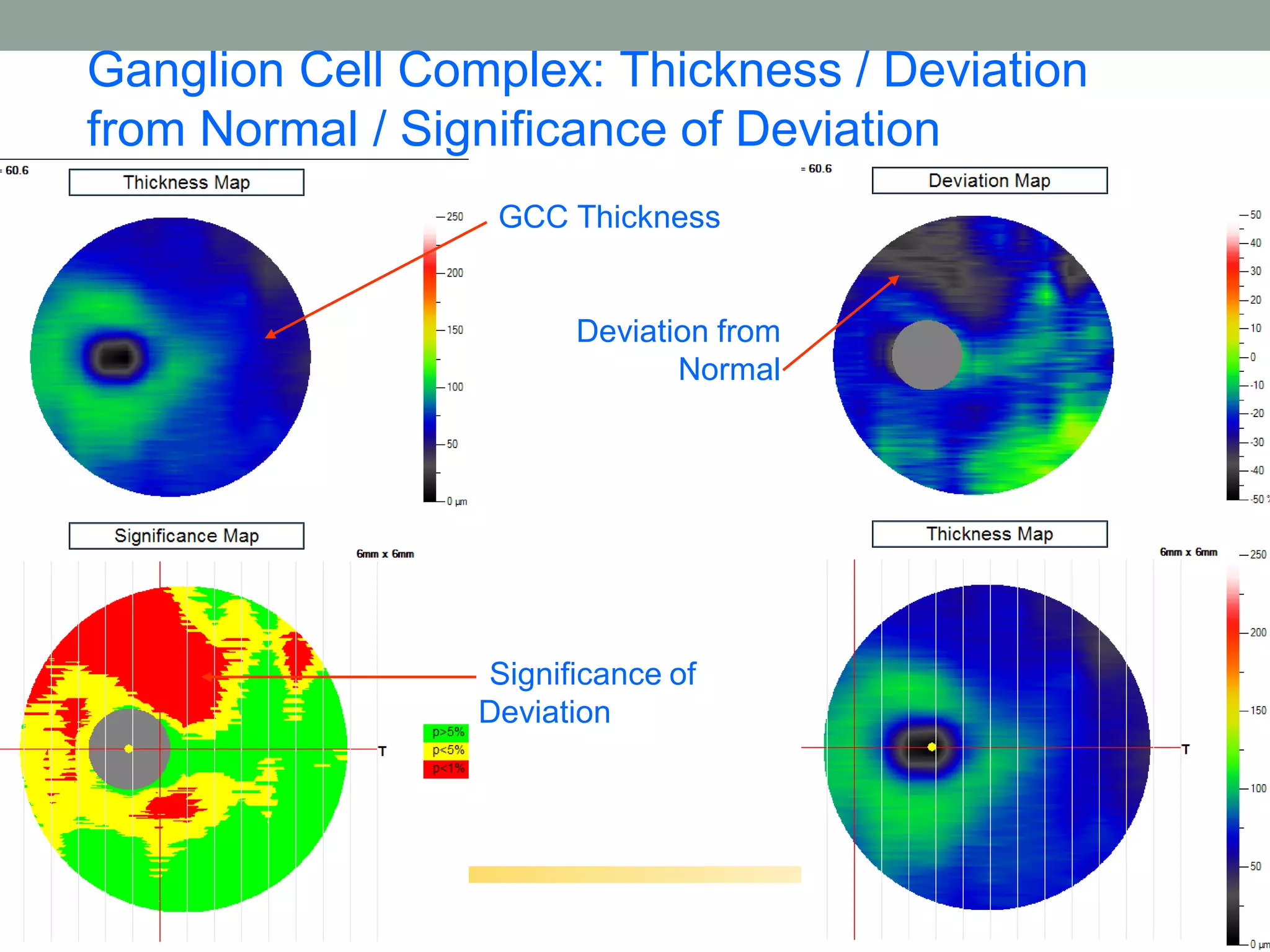 Ganglion Cell Complex: Thickness / Deviation
from Normal / Significance of Deviation
                 • GCC Thickness


                       •Deviation from
                               Normal




                 •Significance of
                 Deviation
 