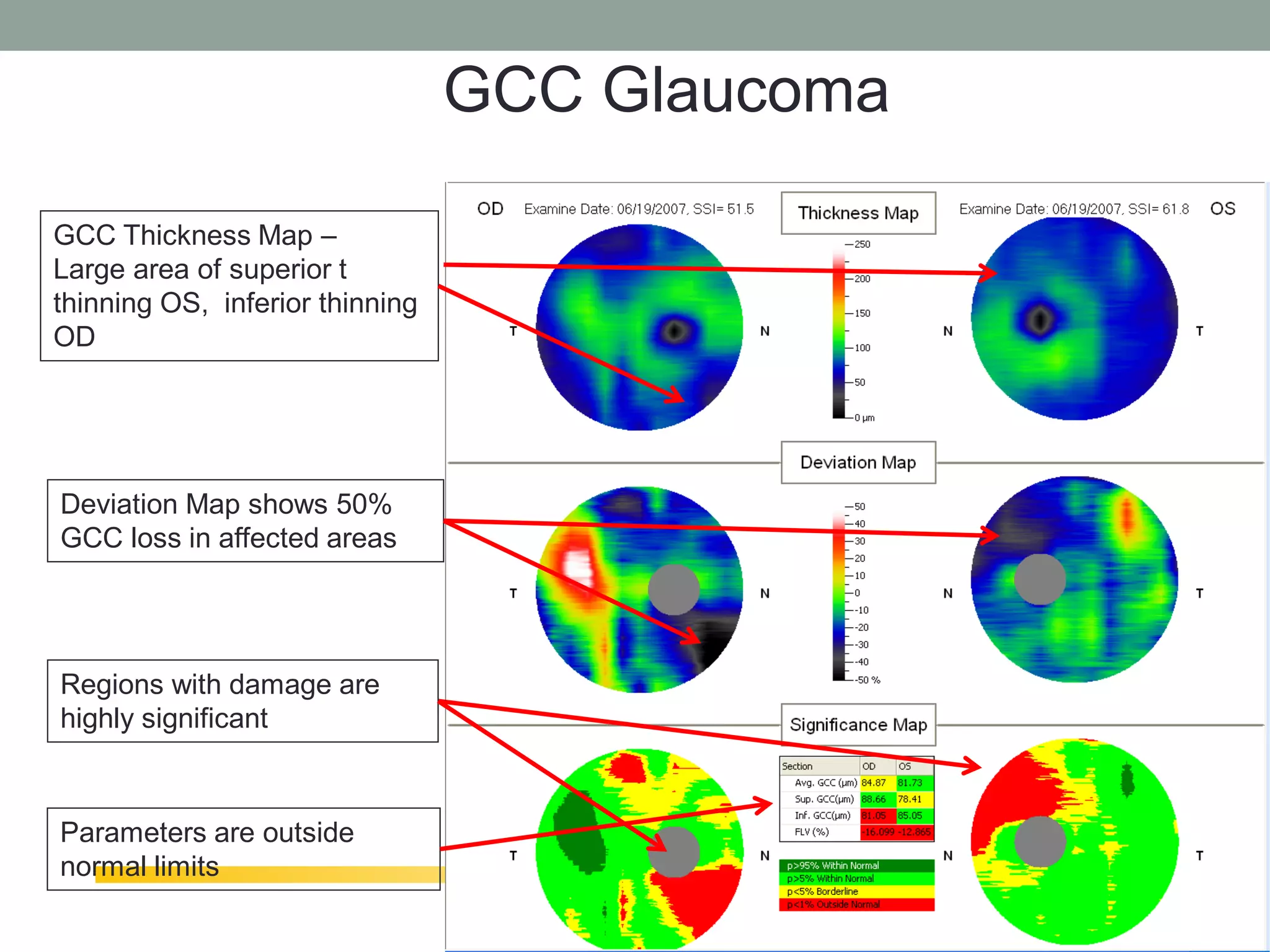 GCC Glaucoma

GCC Thickness Map –
Large area of superior t
thinning OS, inferior thinning
OD




Deviation Map shows 50%
GCC loss in affected areas




Regions with damage are
highly significant



Parameters are outside
normal limits
                                                64
 