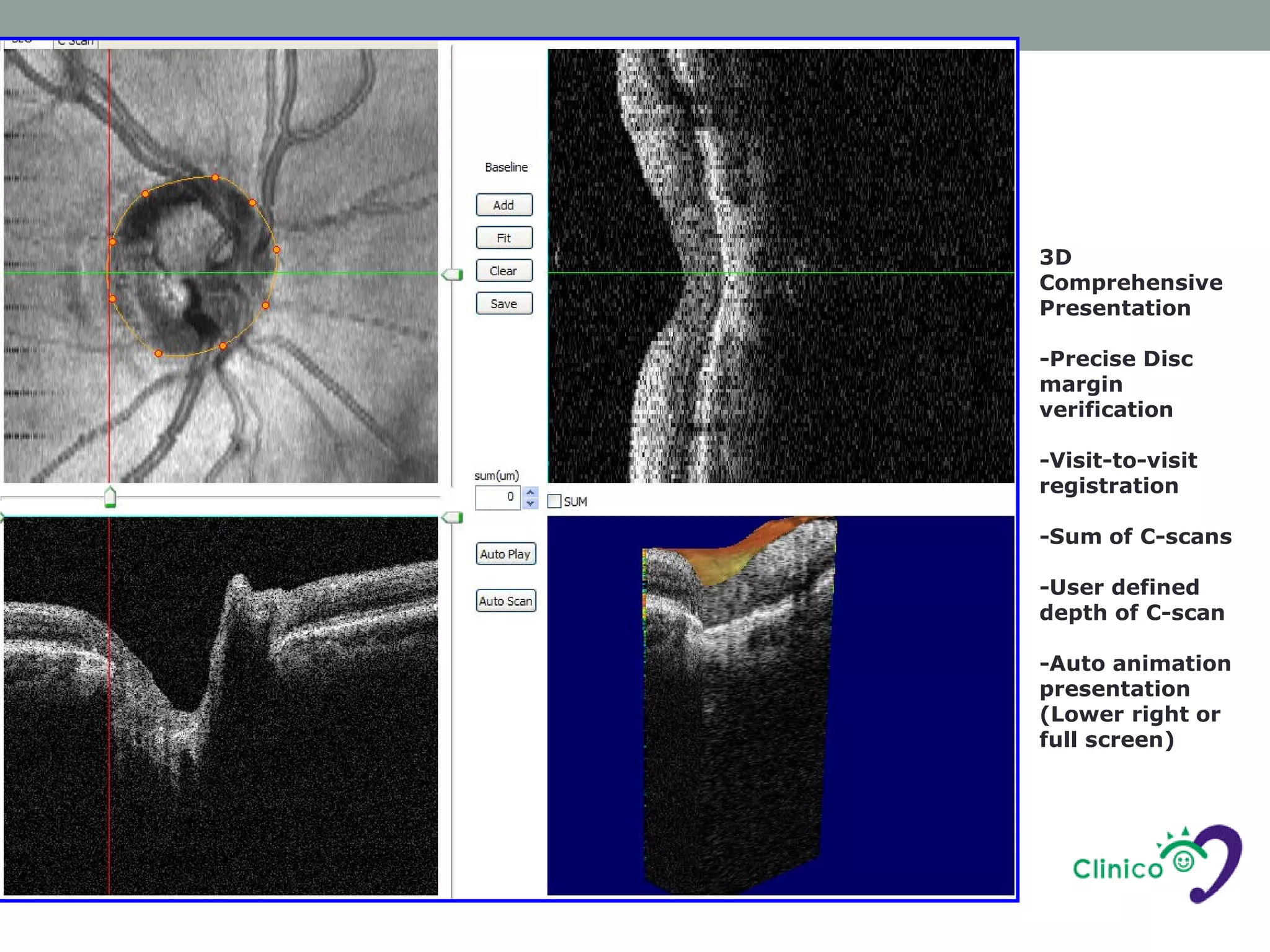 3D
Comprehensive
Presentation

-Precise Disc
margin
verification

-Visit-to-visit
registration

-Sum of C-scans

-User defined
depth of C-scan

-Auto animation
presentation
(Lower right or
full screen)
 