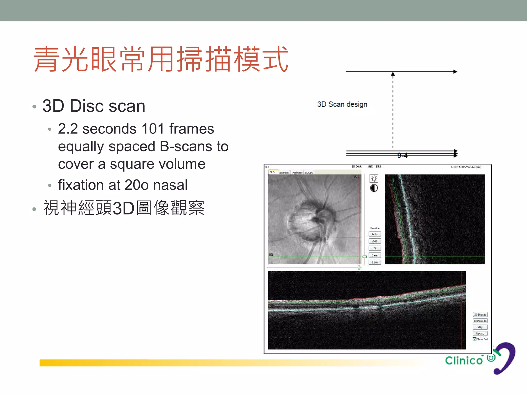 青光眼常用掃描模式
• 3D Disc scan
   • 2.2 seconds 101 frames
     equally spaced B-scans to
     cover a square volume
   • fixation at 20o nasal
• 視神經頭3D圖像觀察
 