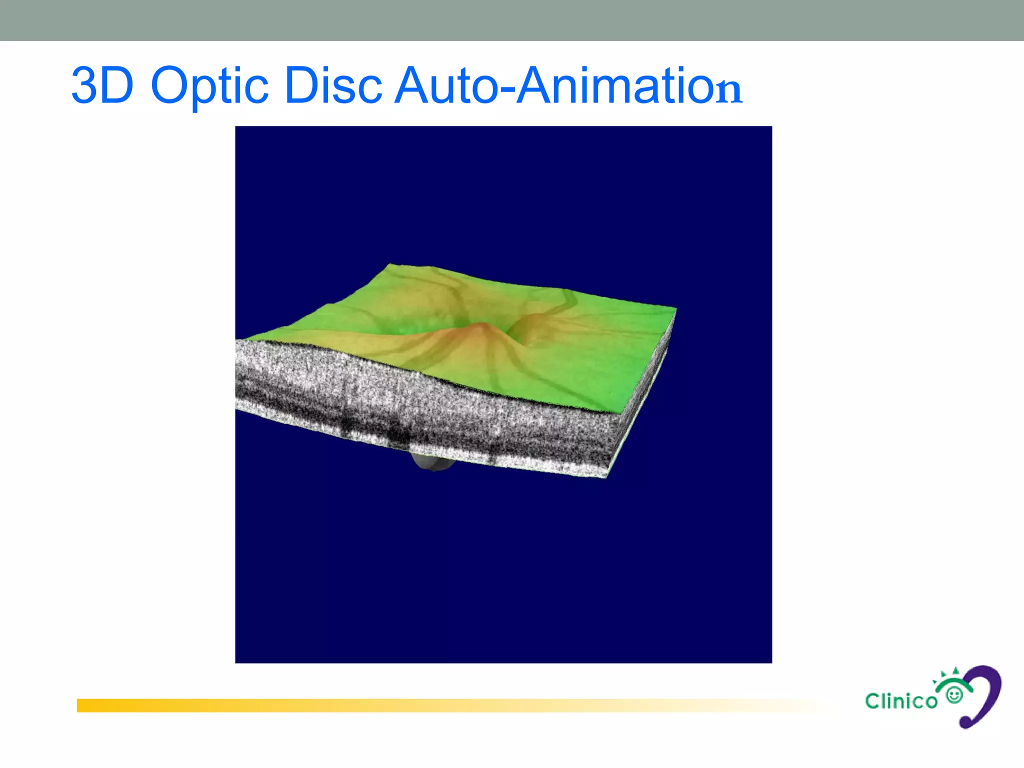 3D Optic Disc Auto-Animation
 