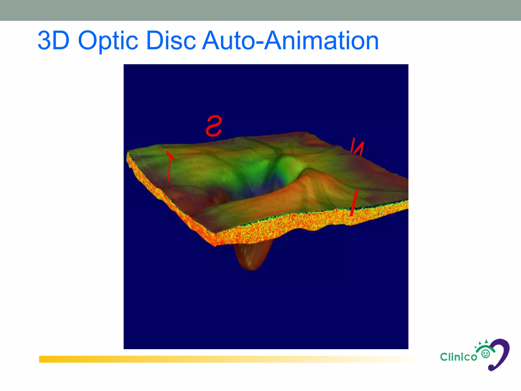 3D Optic Disc Auto-Animation
 