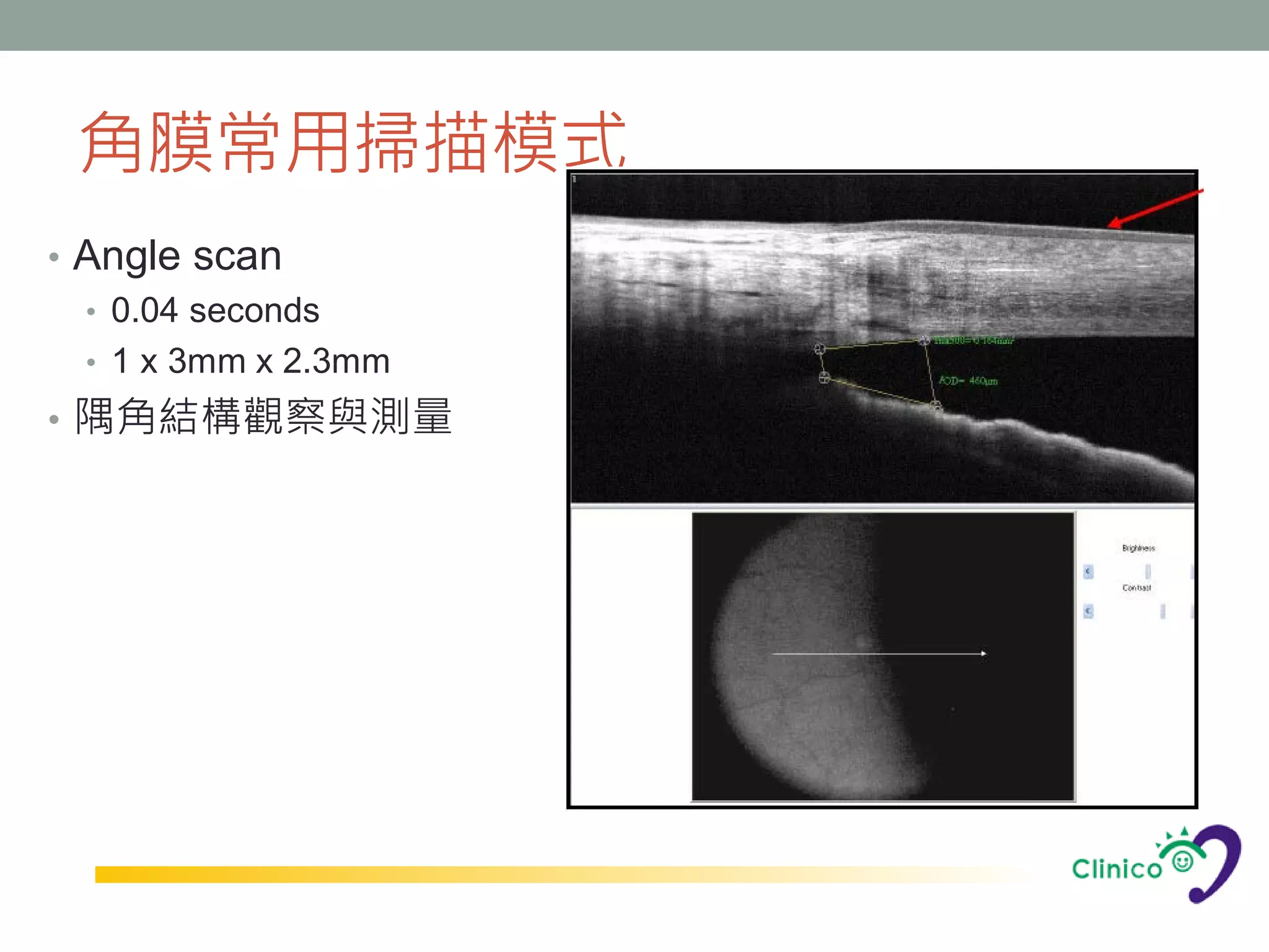 角膜常用掃描模式
• Angle scan
  • 0.04 seconds
  • 1 x 3mm x 2.3mm
• 隅角結構觀察與測量
 