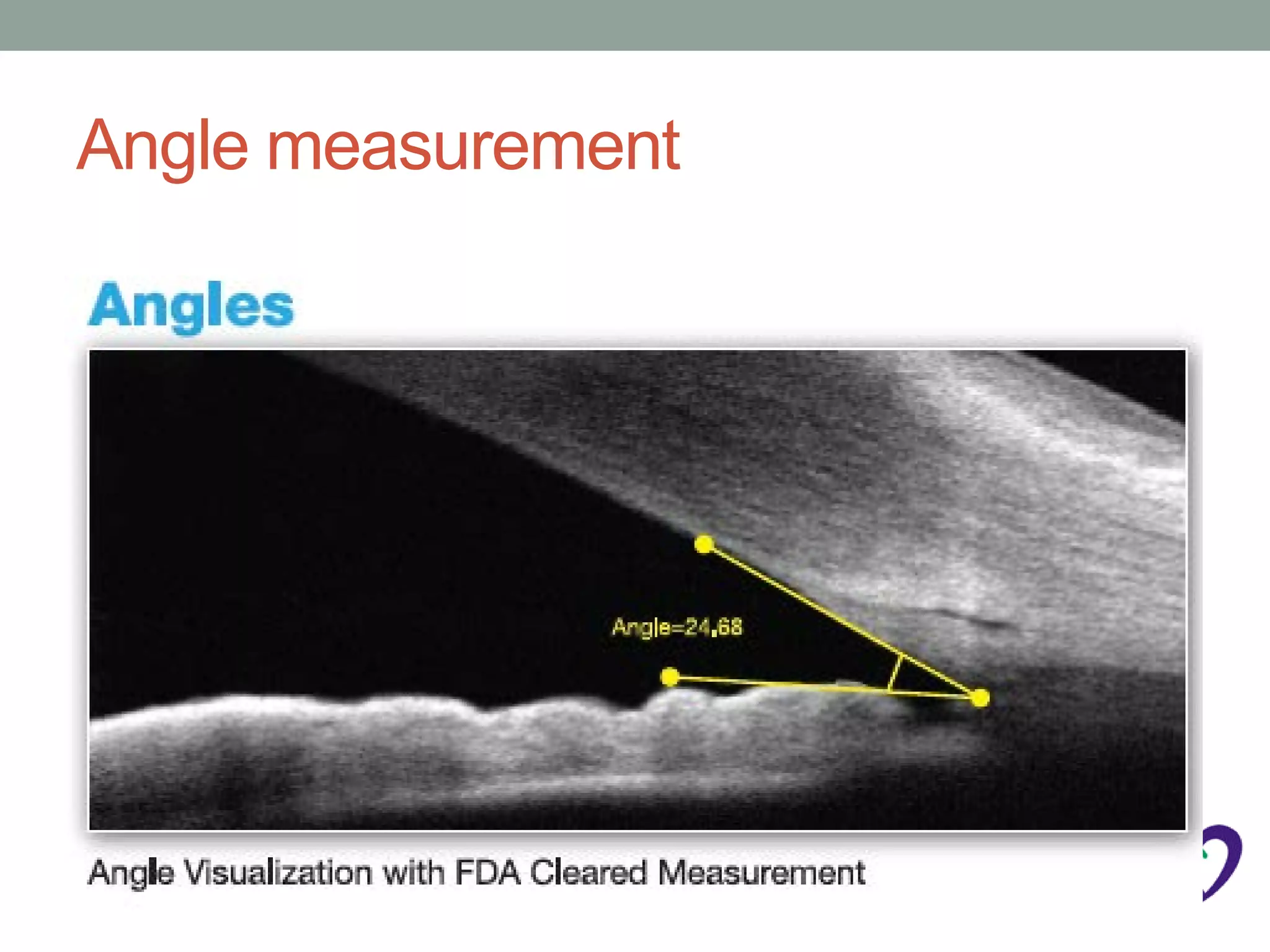 Angle measurement
 