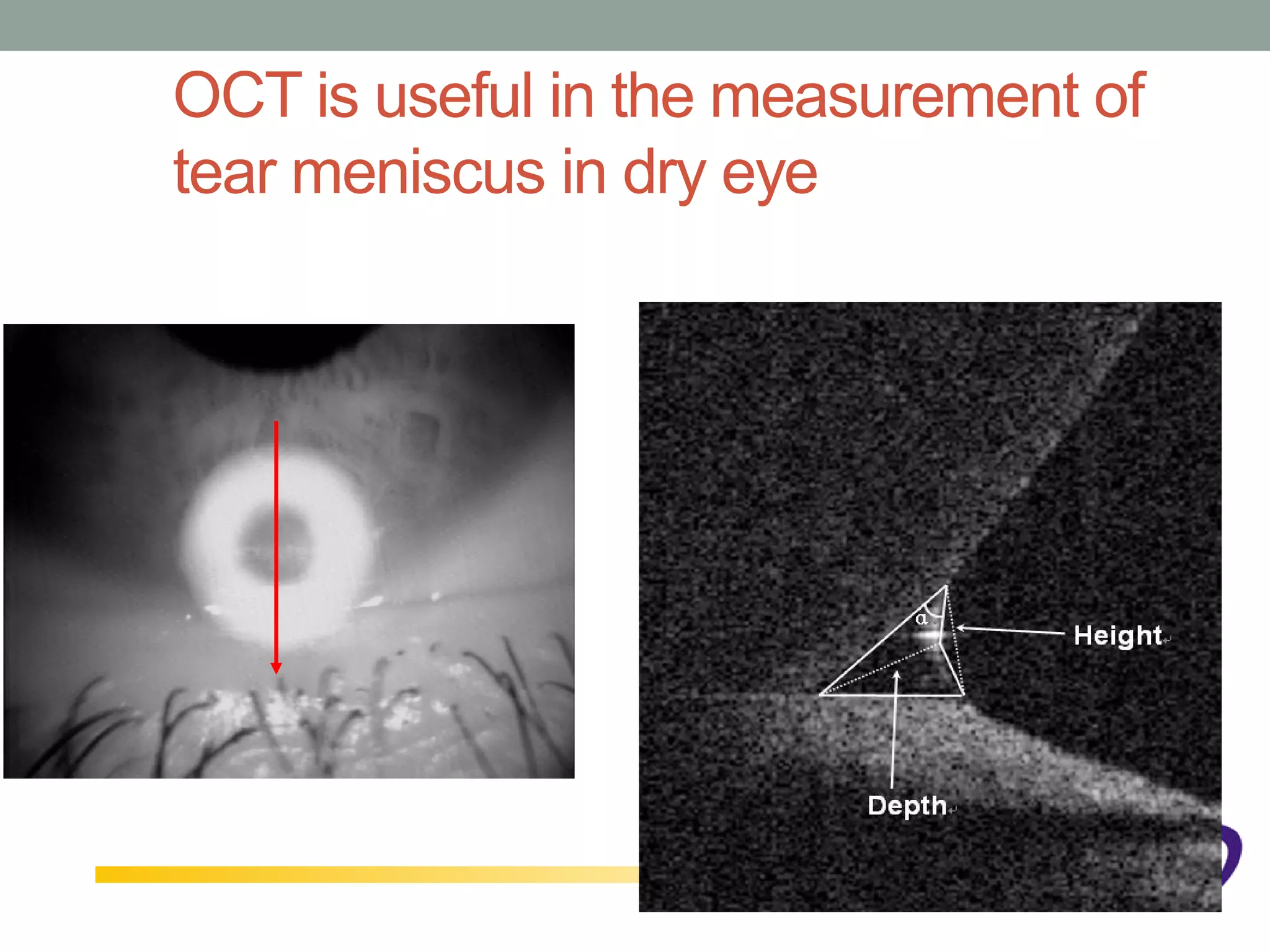 OCT is useful in the measurement of
tear meniscus in dry eye
 