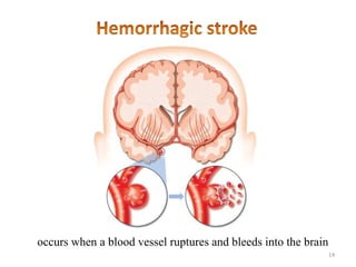 occurs when a blood vessel ruptures and bleeds into the brain
                                                            ...