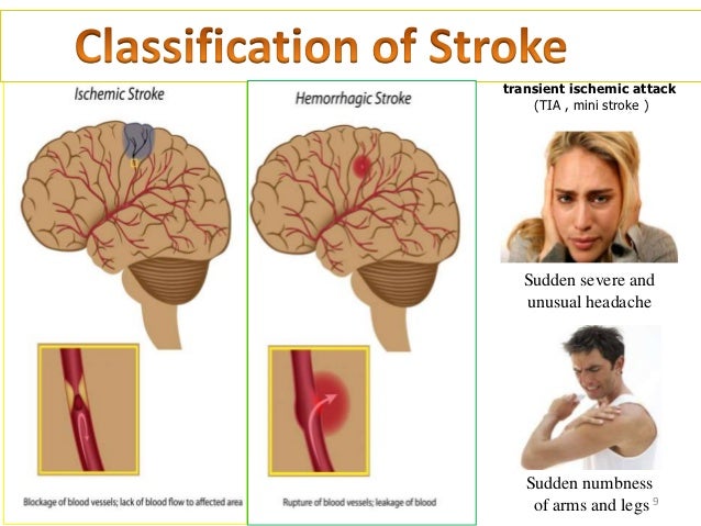 Risk factors of stroke. Fast stroke. Stroke after stroke. Brain repair after stroke. Brain stroke symptoms.