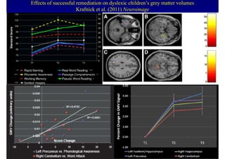 Effects of successful remediation on dyslexic children’s grey matter volumes
                      Krafnick et al. (2011) Neuroimage
 