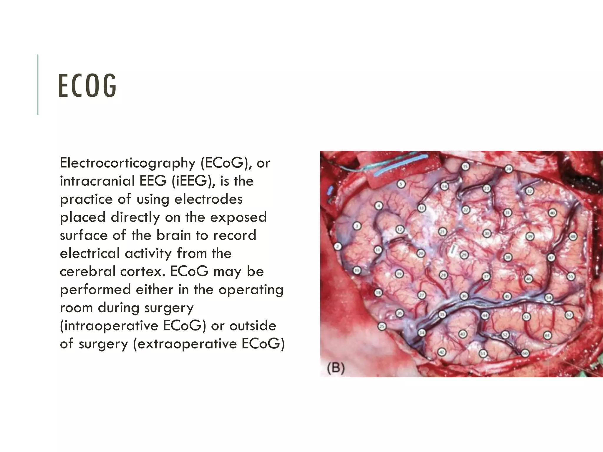 ECOG
Electrocorticography (ECoG), or
intracranial EEG (iEEG), is the
practice of using electrodes
placed directly on the exposed
surface of the brain to record
electrical activity from the
cerebral cortex. ECoG may be
performed either in the operating
room during surgery
(intraoperative ECoG) or outside
of surgery (extraoperative ECoG)

 