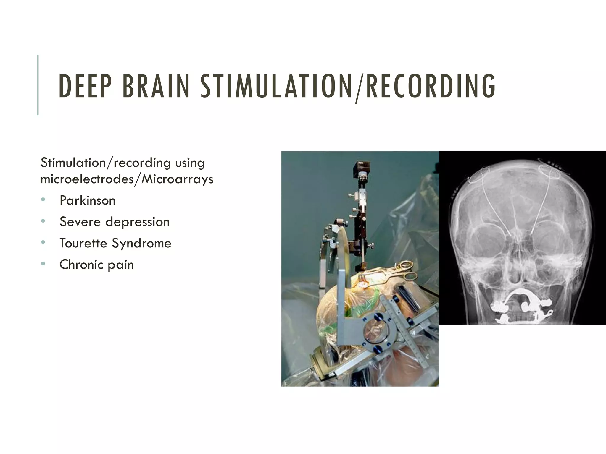 DEEP BRAIN STIMULATION/RECORDING
Stimulation/recording using
microelectrodes/Microarrays
• Parkinson
• Severe depression
• Tourette Syndrome
• Chronic pain

 