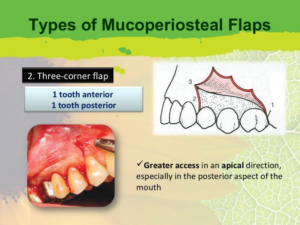 Periodontal Flap Surgery