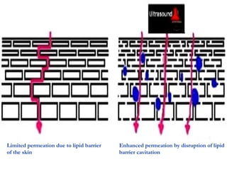 Limited permeation due to lipid barrier
of the skin
Enhanced permeation by disruption of lipid
barrier cavitation
 