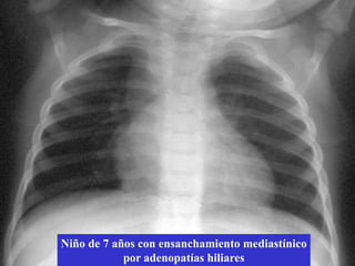 Signos y síntomas de TB pleural (%)

   sudoración        7

   hemoptisis        7

 pérdida peso                      29

dolor torácico                                      58

        fiebre                                           67

           tos                                                   80

                 0       20         40         60          80         100
                              Cruz AT, Pediatr Infect Dis J 2009; 28:981-84
 
