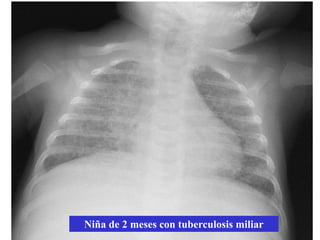 Criterios de ingreso de TB en niños

- Menores de dos años.
- Formas pulmonares graves (derrame pleura, atelectasia franca)
- Formas graves o diseminadas
- Formas extrapulmonares, salvo formas ganglionares aisladas.
- Formas bacilíferas: Poco frecuente en niños: formas cavitadas.
- Sospecha de TB resistente a fármacos
- Fracaso de tratamiento previo (tras al menos 2 meses del mismo)
- Sospecha o riesgo de incumplimiento terapéutico.
- Tuberculosis en el inmunodeprimido
 